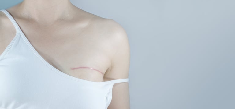 Breast cancer surgery scars after partial mastectomy, restored client with confidence