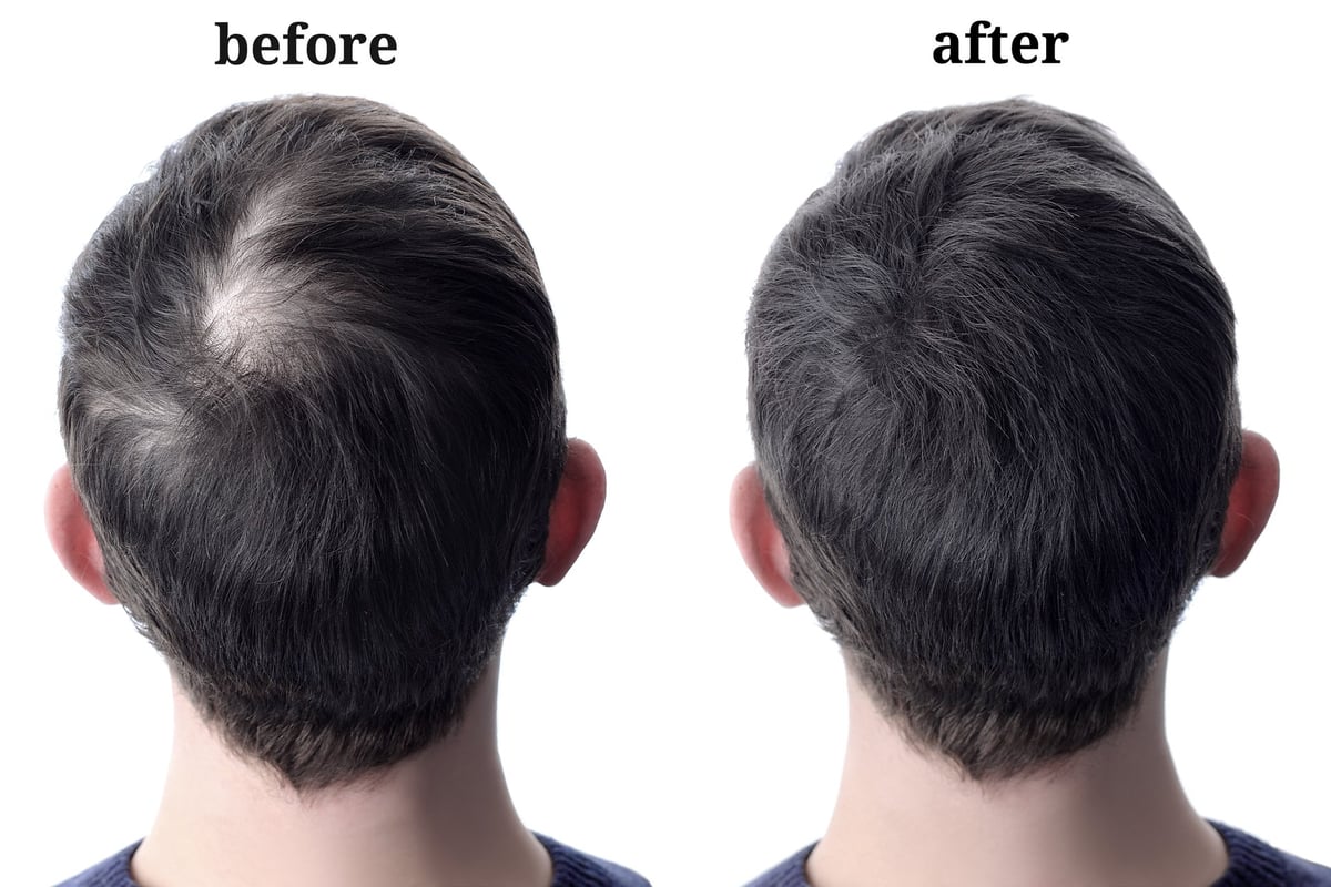 Before and after scalp micropigmentation for extensive hair loss in Bradenton FL — fuller scalp coverage at CC Styling Studio
