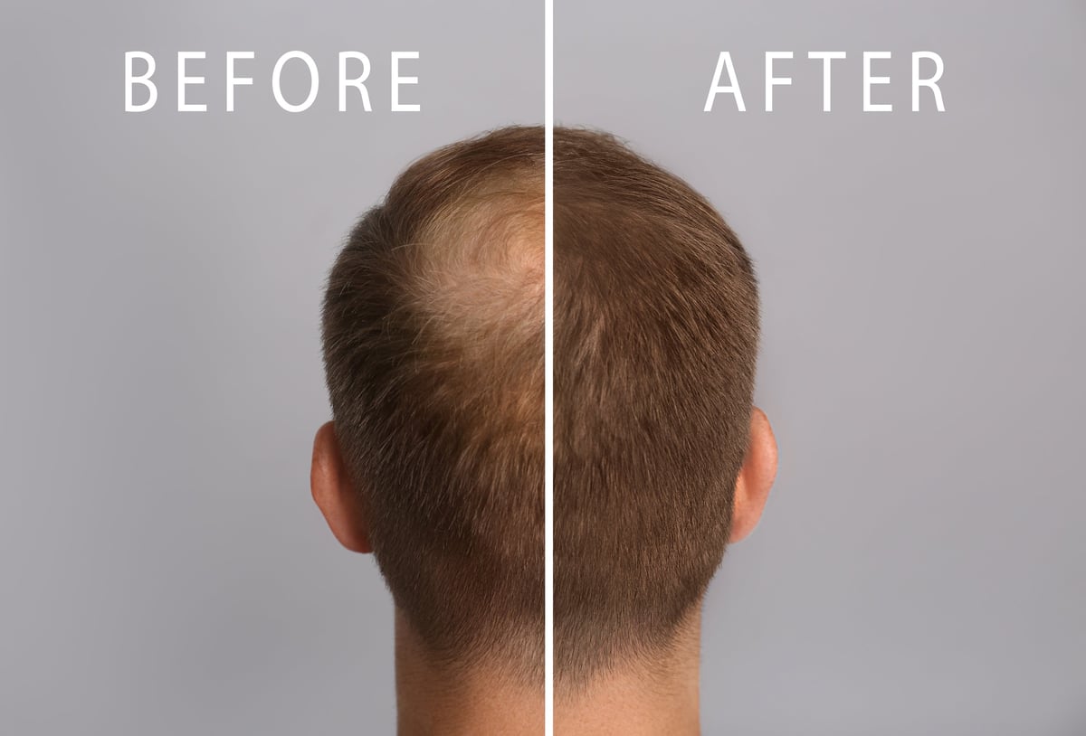 Before and after scalp micropigmentation for hair loss in Bradenton FL — restored hairline and natural coverage at CC Styling Studio