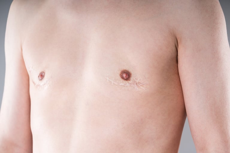 Torso showing surgical scars after breast reconstruction, medical healthcare concept