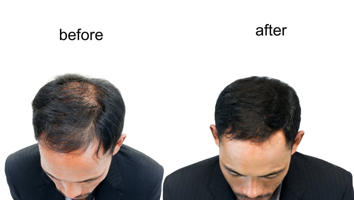 Before and after scalp micropigmentation result in Bradenton FL — bald scalp restored to a natural, undetectable full-density finish at CC Styling Studio