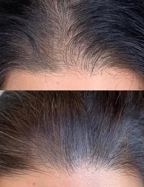 Before and after comparison of hair regrowth, showing hairline density improvement on forehead area