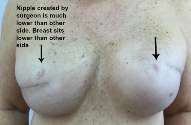 Medical image showing breast asymmetry with annotations indicating surgical nipple placement and breast positioning differences