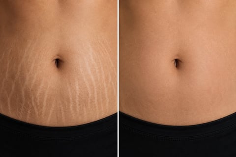 Before and after comparison of skin showing reduction in stretch marks on abdomen