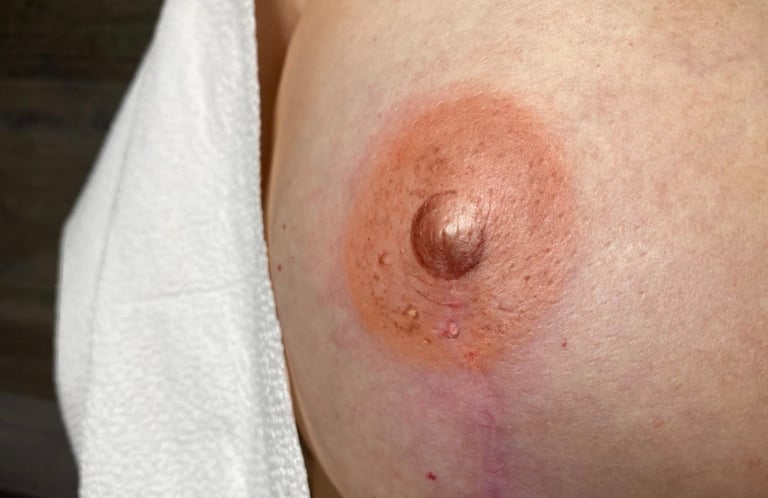 Close-up of human nipple and areola on pale skin with white fabric partially visible, showing natural areola restoration result