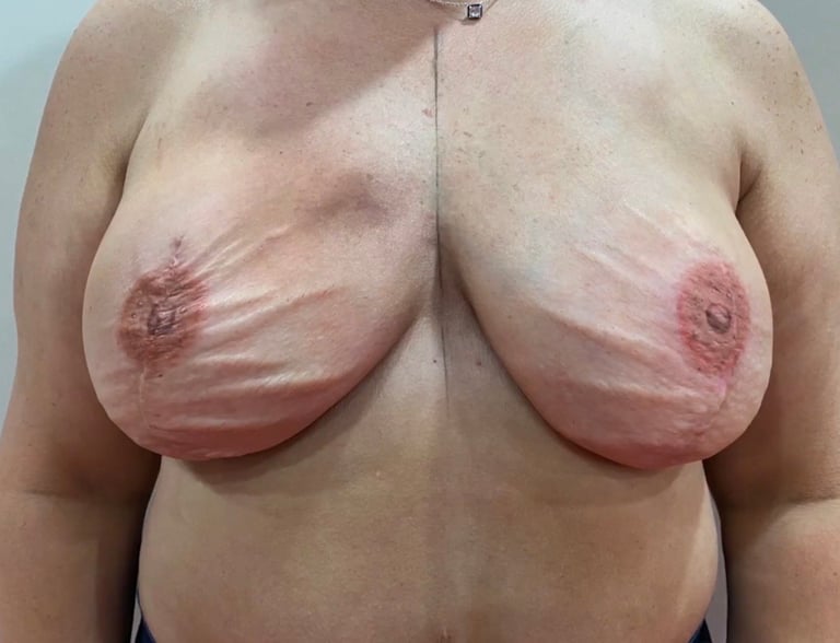 Nude artistic photograph showing frontal torso of mature individual