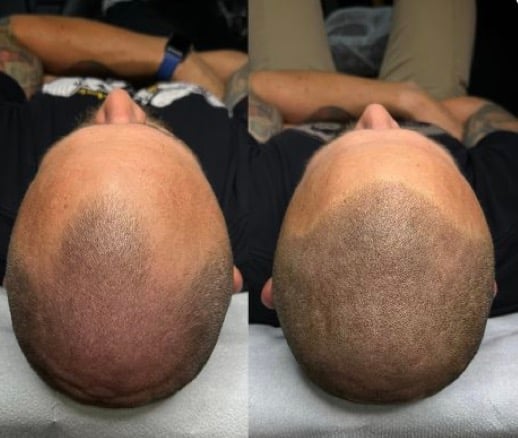Before and after comparison showing head with hair growth results on light-colored background