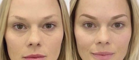 Before and after facial comparison showing skin texture and appearance changes